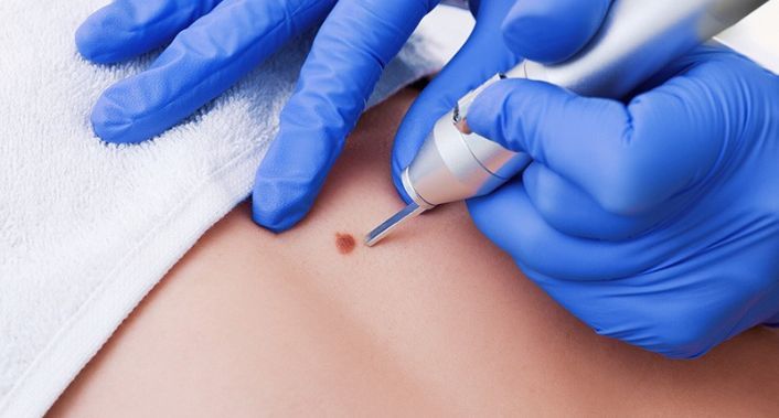 Harmonise Estética Avançada, Remoção de sinais (até 10 sinais) + Procedimento de Alta Frequência Harmonise Estética Avançada, Remoção de sinais (até 10 sinais) + Procedimento de Alta Frequência