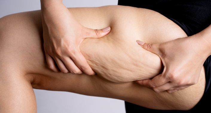 Instituto Derma, Lipedema Zero: Acabe de vez com a gordura localizada!