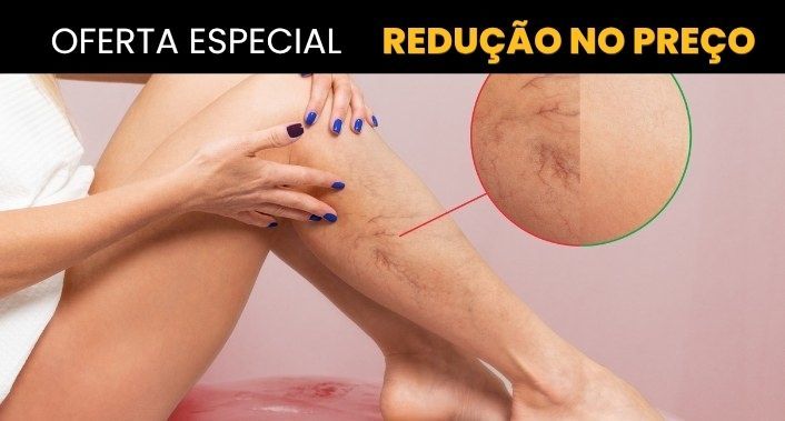 Insigne Estética Premium, Tratamento para Microvasos e Varizes (PEIM) na Insigne Estética Premium