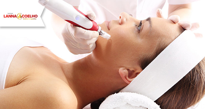 Higienização + Microagulhamento com vitamina C e Ácido Hialurônico + Ledterapia Higienização + Microagulhamento com vitamina C e Ácido Hialurônico + Ledterapia