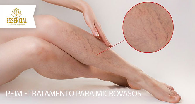 2 sessões de tratamento para microvasos (PEIM) na Essencial Estética Avançada 2 sessões de tratamento para microvasos (PEIM) na Essencial Estética Avançada